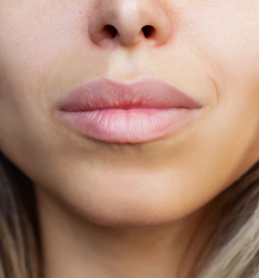 Lippen nach der Behandlung – sichtbar mehr Volumen und Kontur.