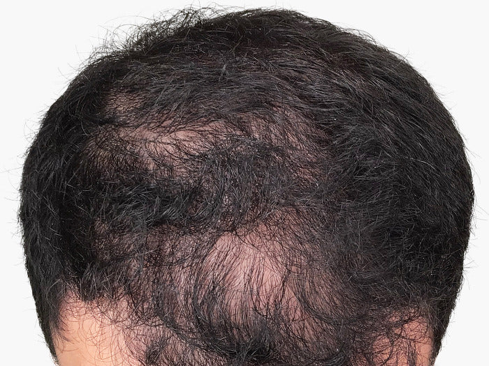 Mann mit fortgeschrittenem Haarausfall auf dem Oberkopf