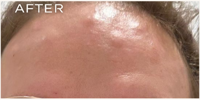 Vorher-Nachher-Vergleich einer Stirnfalten-Behandlung bei Mann