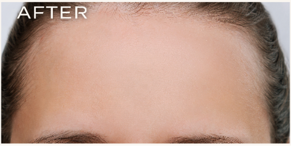 Vorher-Nachher-Vergleich einer Stirnfalten-Behandlung bei Frau