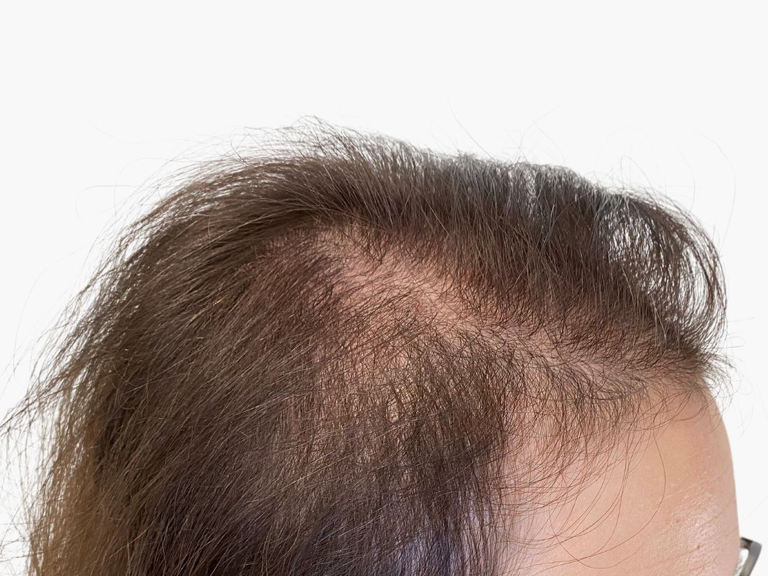 Frau mit sichtbar lichtem Haar im Stirnbereich – Haarausfall vor der Behandlung