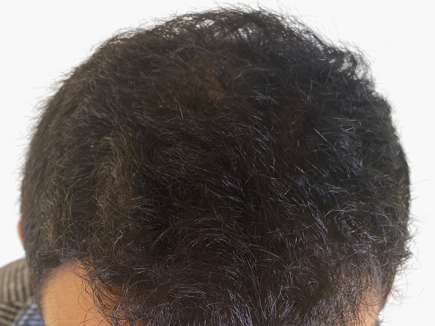 Obere Kopfansicht eines Mannes mit lichtem Haar im Tonsurbereich – typische Haarausfall-Situation